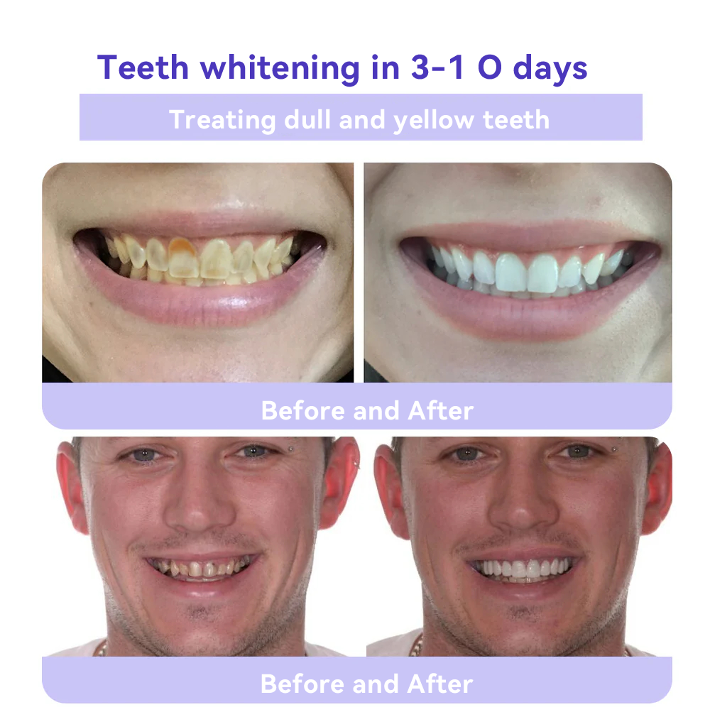 Oyikey® 🎁 Polvo Mineral para Restauración Dental (Blanqueamiento, Restauración de la Salud Dental)