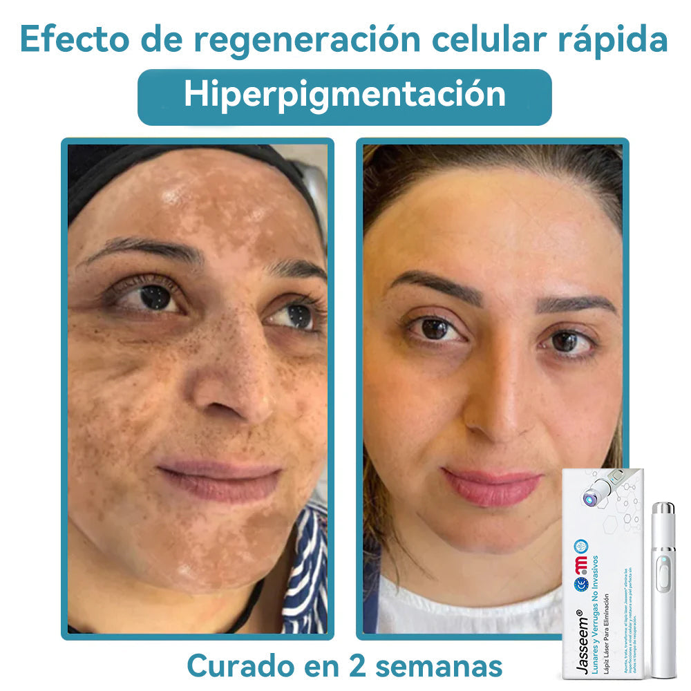 𝐉𝐚𝐬𝐬𝐞𝐞𝐦® Lápiz Láser de Grado Médico 🎁🎁 (Tecnología Láser de Dióxido de Carbono – Eficaz para Eliminar Lunares, Verrugas, Excesos de Piel, Manchas de Pigmentación y Otros Defectos de la Piel)