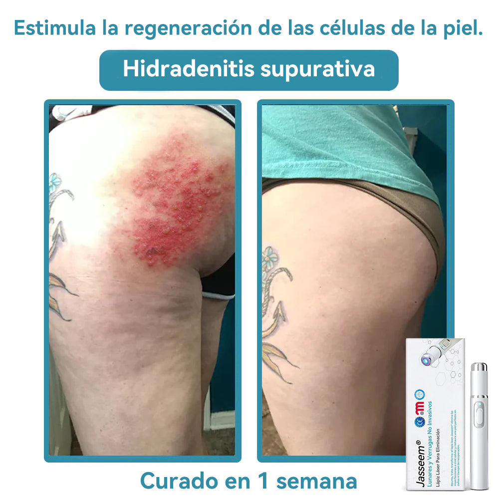 𝐉𝐚𝐬𝐬𝐞𝐞𝐦® Lápiz Láser de Grado Médico 🎁🎁 (Tecnología Láser de Dióxido de Carbono – Eficaz para Eliminar Lunares, Verrugas, Excesos de Piel, Manchas de Pigmentación y Otros Defectos de la Piel)