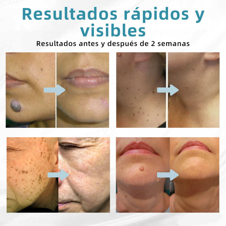 𝐉𝐚𝐬𝐬𝐞𝐞𝐦® Lápiz Láser de Grado Médico 🎁🎁 (Tecnología Láser de Dióxido de Carbono – Eficaz para Eliminar Lunares, Verrugas, Excesos de Piel, Manchas de Pigmentación y Otros Defectos de la Piel)