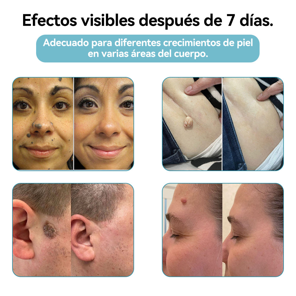 𝐉𝐚𝐬𝐬𝐞𝐞𝐦® Lápiz Láser de Grado Médico 🎁🎁 (Tecnología Láser de Dióxido de Carbono – Eficaz para Eliminar Lunares, Verrugas, Excesos de Piel, Manchas de Pigmentación y Otros Defectos de la Piel)