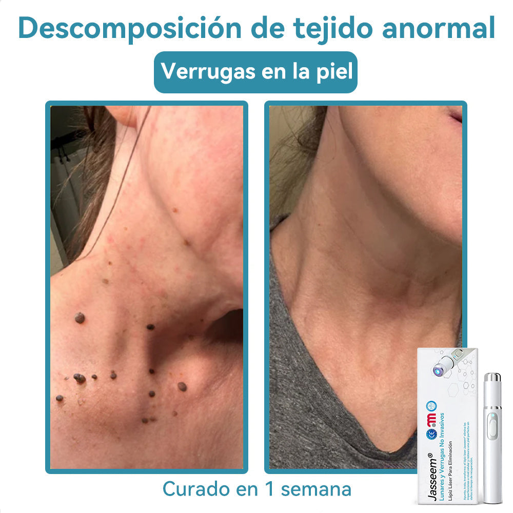 𝐉𝐚𝐬𝐬𝐞𝐞𝐦® Lápiz Láser de Grado Médico 🎁🎁 (Tecnología Láser de Dióxido de Carbono – Eficaz para Eliminar Lunares, Verrugas, Excesos de Piel, Manchas de Pigmentación y Otros Defectos de la Piel)