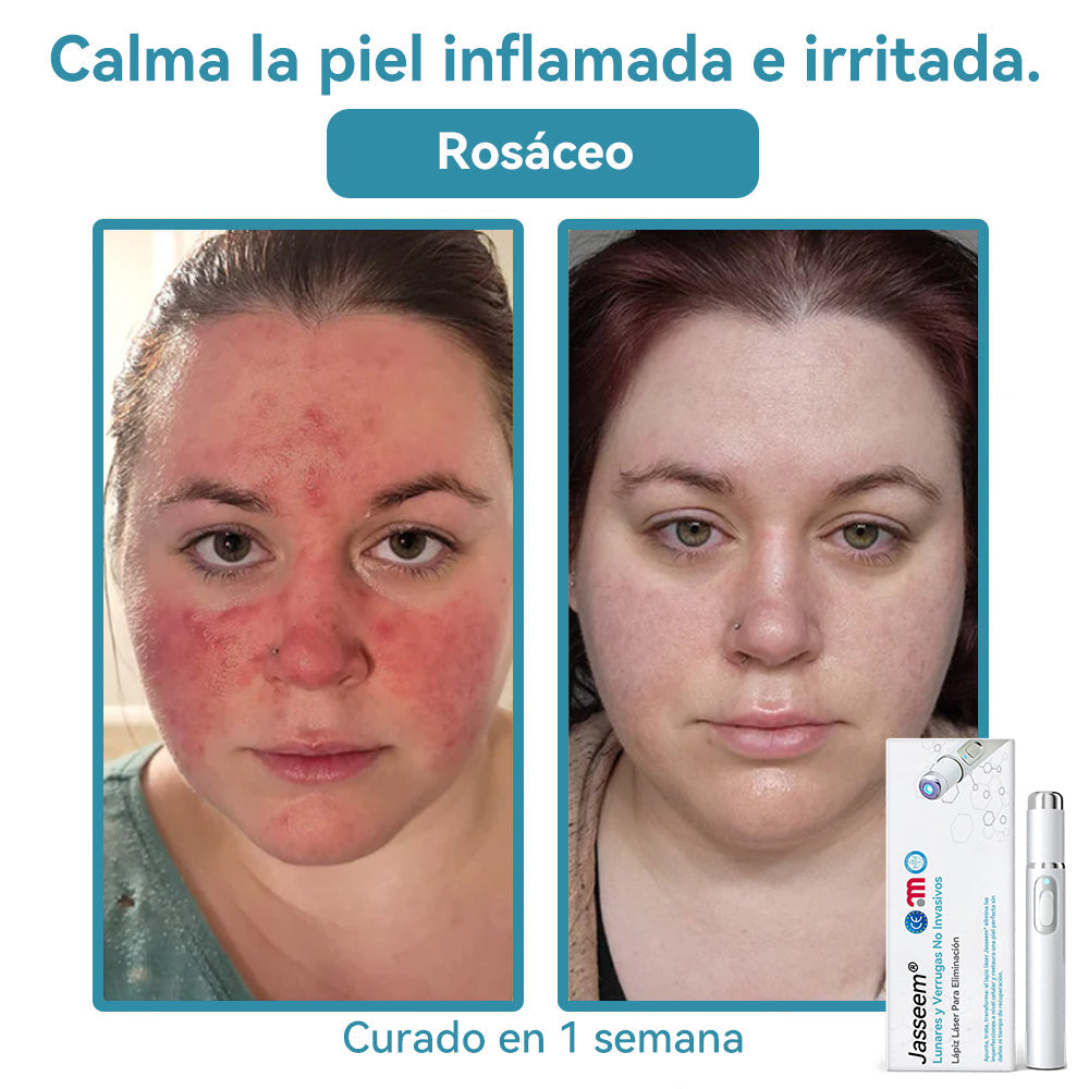 𝐉𝐚𝐬𝐬𝐞𝐞𝐦® Lápiz Láser de Grado Médico 🎁🎁 (Tecnología Láser de Dióxido de Carbono – Eficaz para Eliminar Lunares, Verrugas, Excesos de Piel, Manchas de Pigmentación y Otros Defectos de la Piel)